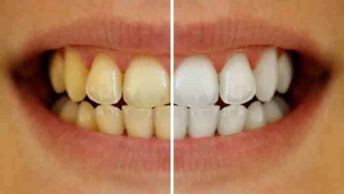get-rid-from-yellow-teeth-problem